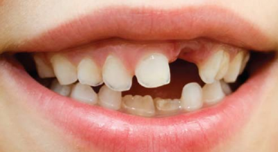 Diş Çarpıklığı İçin Diş Teli Şart